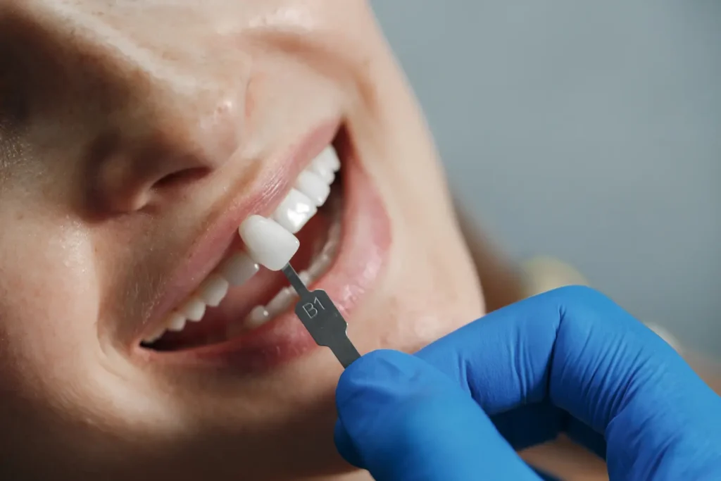 Corona dental: todo lo que debes saber 3 Manos de un dentista probando sobre una sonrisa el tono de blanco de una corona dental