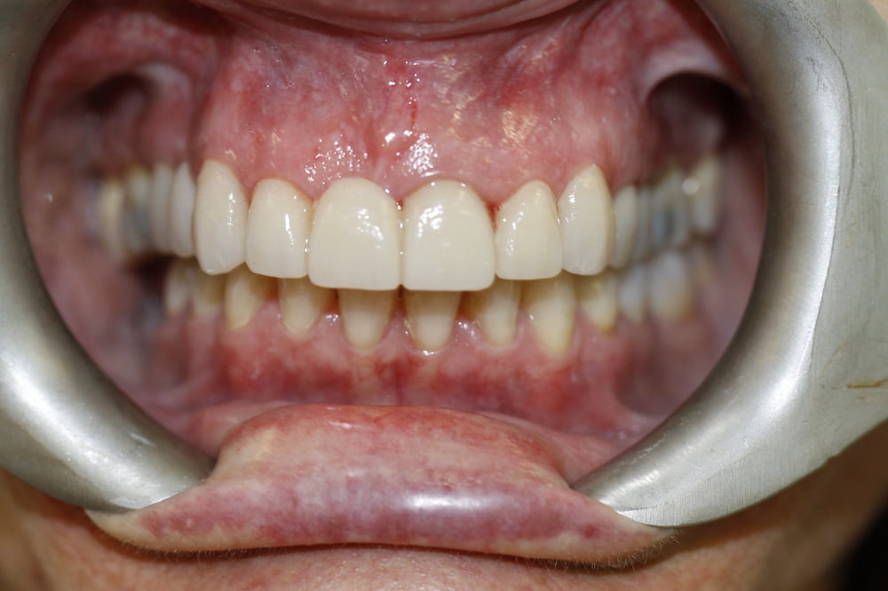 despues de corona dental