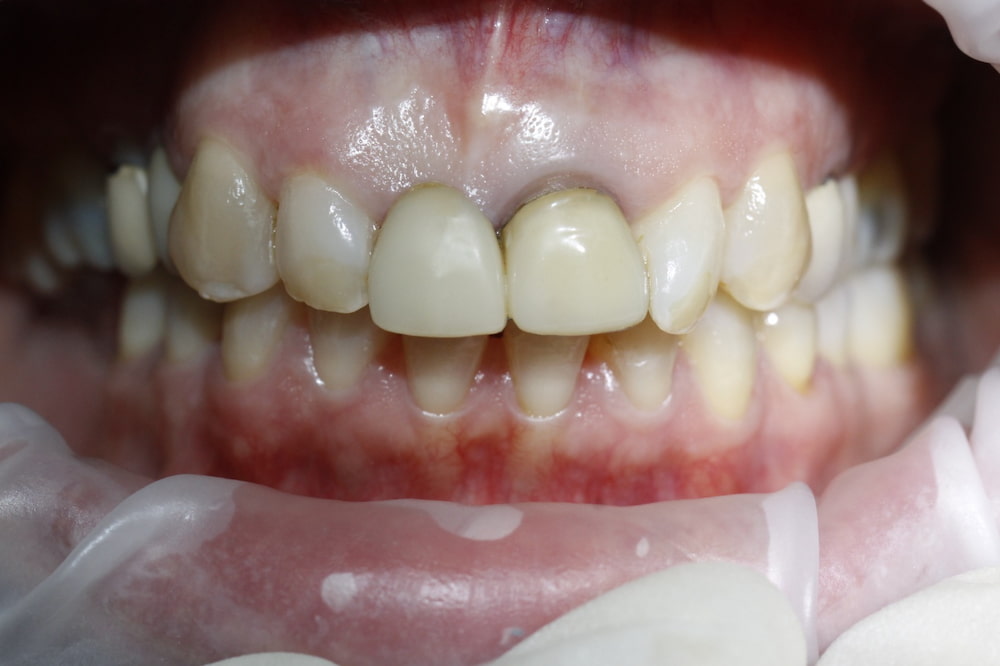 antes de corona dental 
